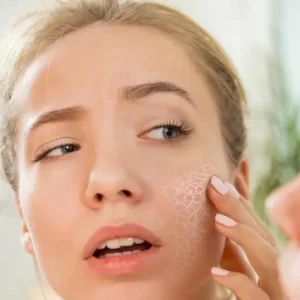 Mengatasi Masalah Kulit Kering dan Dehidrasi